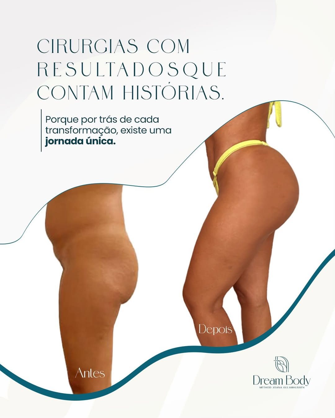 Cirurgias com resultados que contam histórias — Dream Body Clinic